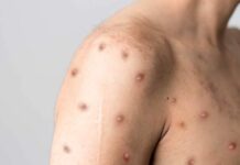 MÉXICO REGISTRA 55 CASOS EN 9 ENTIDADES; SALUD AMPLÍA MEDIDAS PREVENTIVAS