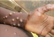 México está preparado para enfrentar la viruela del mono, asegura SSa; suman 60 casos.
